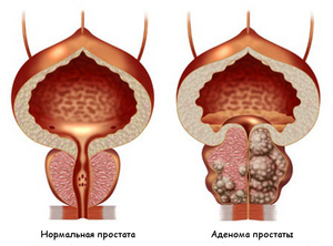 Воспаленная простата - причины и последствия заболевания
