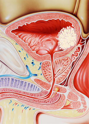 Как развивается болезнь мочеполовой системы