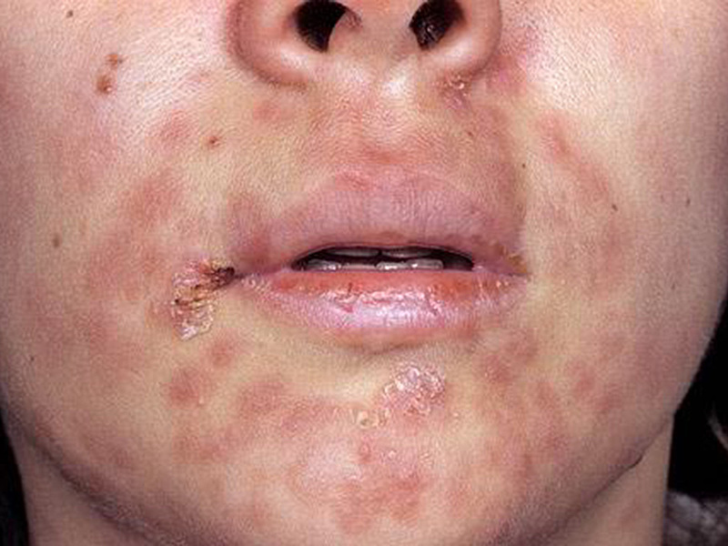 Вторичный сифилис - проявления болезни на лице
