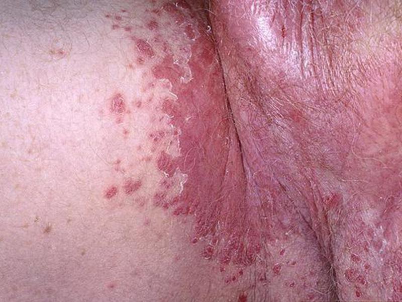 Сыпь в паху может быть признаком сифилиса