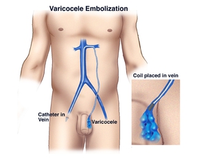 Как диагностируют заболевание варикоцеле