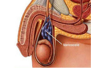 Как проявляется варикоцеле