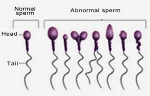 Слева - нормальная сперма, справа - патологическая