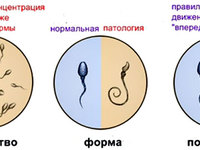 Олигозооспермия - особенности патологии