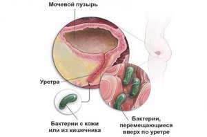 Лечение мочевого пузыря