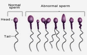 Не здоровые сперматозоиды