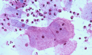 Гарднереллез у мужчин - возбудитель болезни под микроскопом