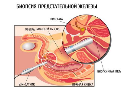 Последствия биопсии предстательной железы как себя вести после операции