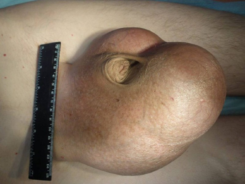На фото показано воспаление яичка