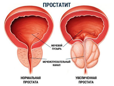 Виды препаратов при псориазе