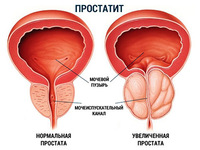 Как вылечить простатит