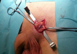 Варикоцеле у мужчин - операция в процессе